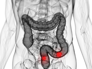 Proinflammatory Diet Linked to Increased Risk for Colorectal Cancer
